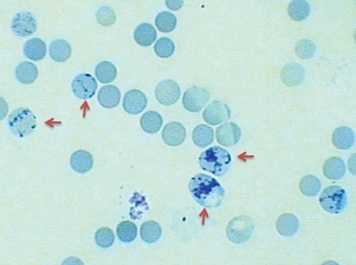 Retic count in sickle cell